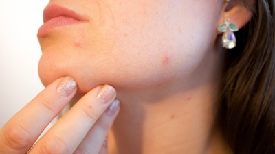 Jak leczyć trądzik – wskazówki dermatologa